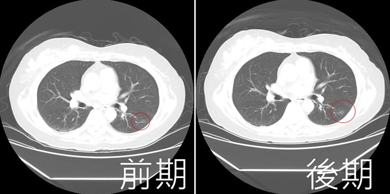劉柏毅醫師透過低劑量電腦斷層掃描追蹤肺結節病徵進度
